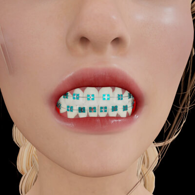 Braces for G8F, G8.1F, G9F 1 https://new.imagehostx.com/upload/2025/10/07/IMG-126036ef78d8b0dd1491_1759817765.jpg